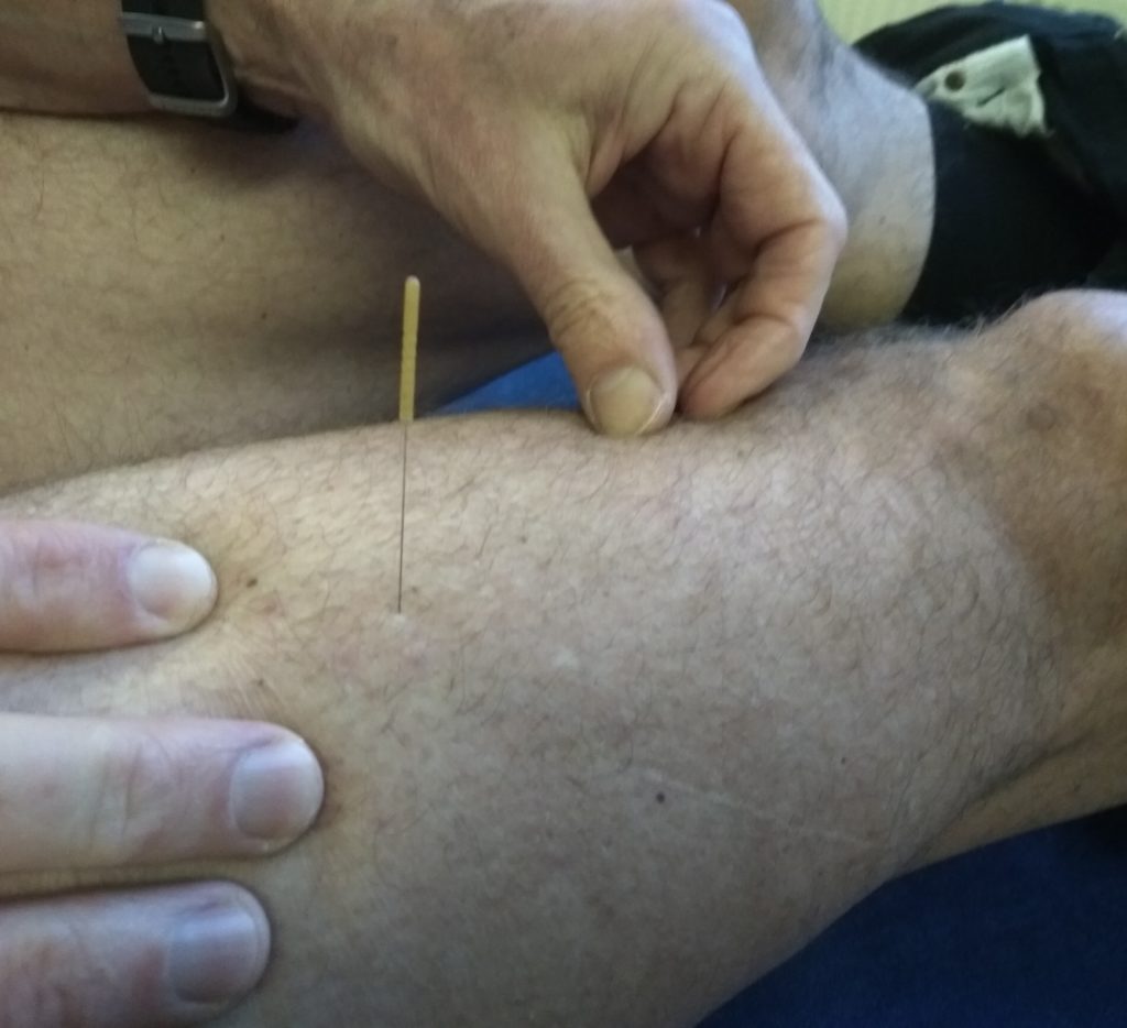 Dry Needling